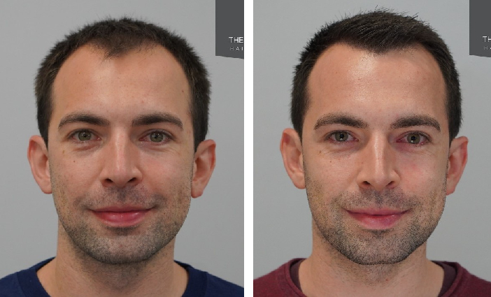 before and after hair transplant at the Maitland Clinic