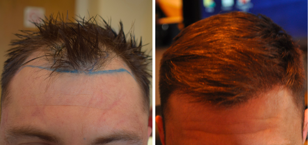 before and after hair transplant