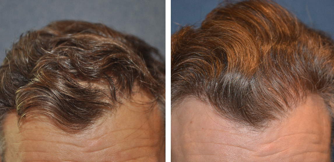 before and after wavy hair transplant