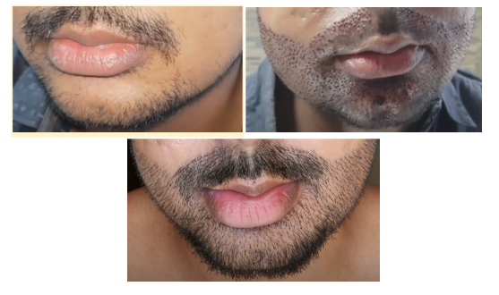 before beard transplant, immediately after beard transplant, and 10 days after hair transplant