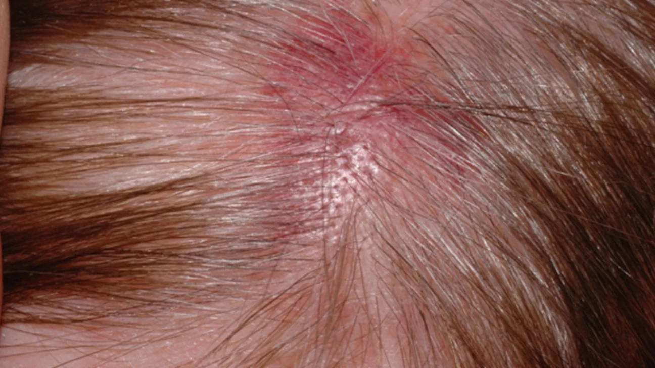 blister on scalp