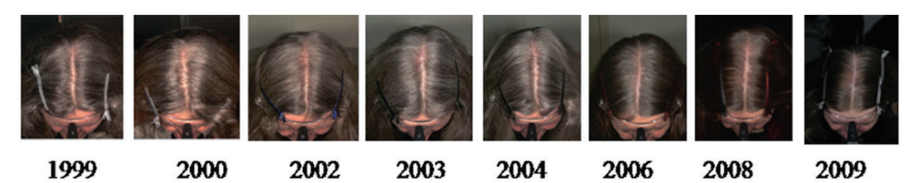 Chronic telogen effluvium over 10 years