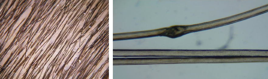 close-up examples of Trichorrhexis Invaginata (Bamboo Hair)