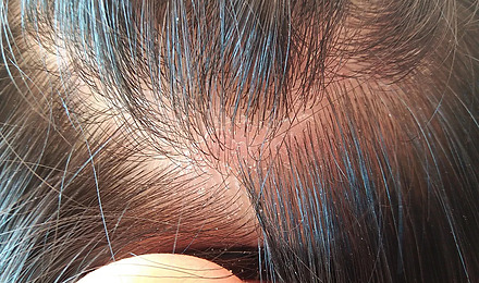 Can A Dry Scalp Cause Hair Loss? Prevention & Treatment Tips