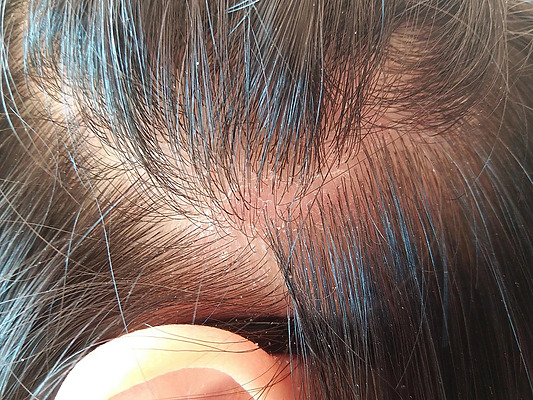 Can a Dry Scalp Cause Hair Loss? Prevention & Treatment Tips