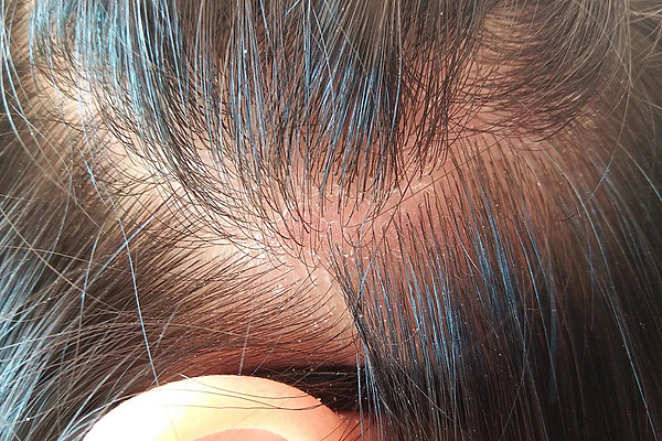 Can A Dry Scalp Cause Hair Loss? Prevention & Treatment Tips