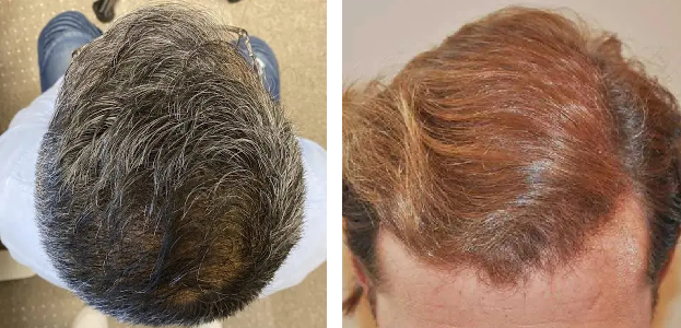 crown hair transplants