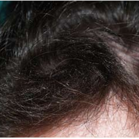 hair damage caused by excessive brushing