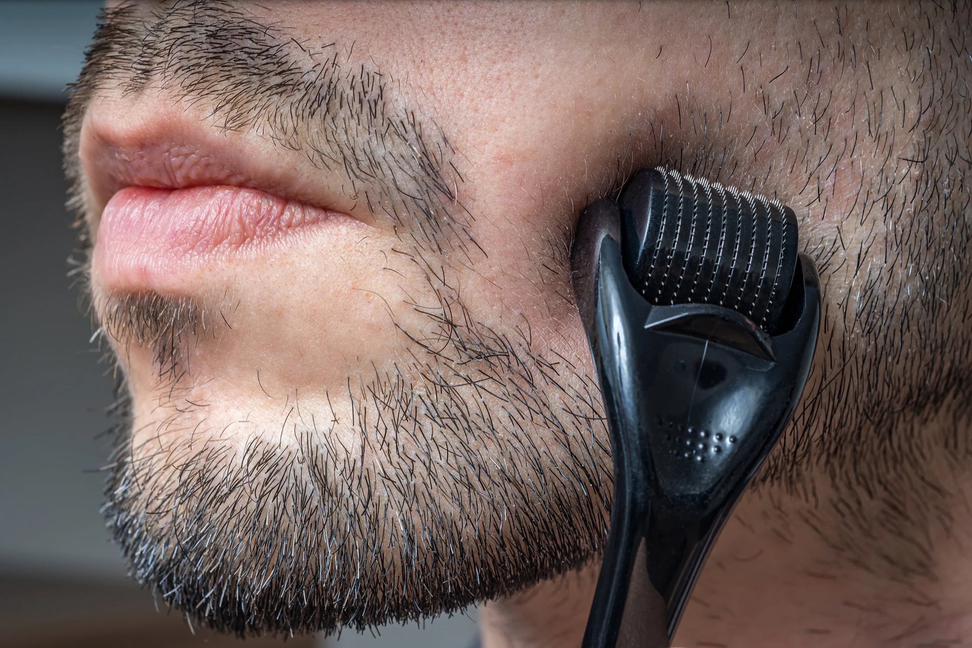 derma roller used on a beard