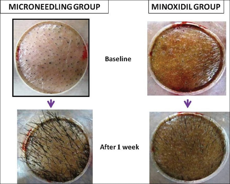 Minoxidil combined with beard roller increases hair growth