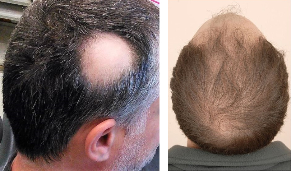 different types of hair loss: alopecia areata and male pattern baldness