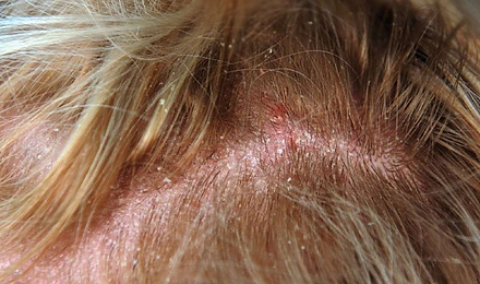 Diseased Scalp