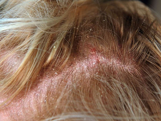 diseased scalp