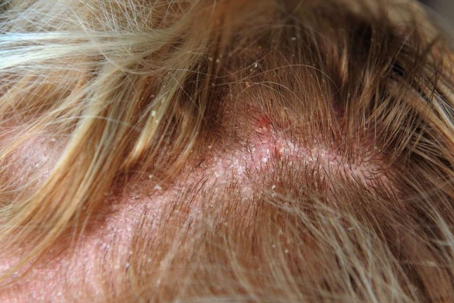 Diseased Scalp