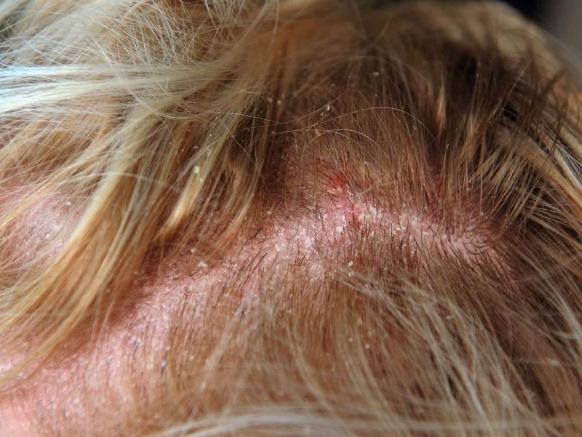 diseased scalp