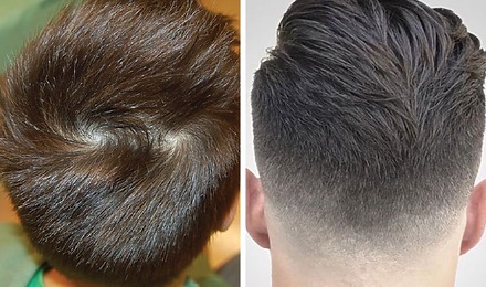 Double Crown Vs Balding: Differences, Symptoms, Treatments