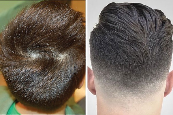 Double Crown Vs Balding: Differences, Symptoms, Treatments