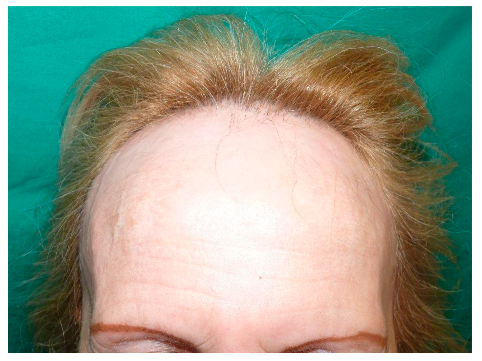 example of frontal fibrosing alopecia