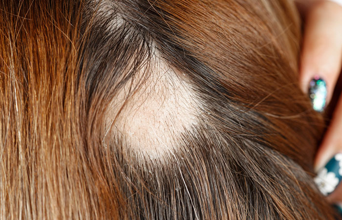 example of trichotillomania