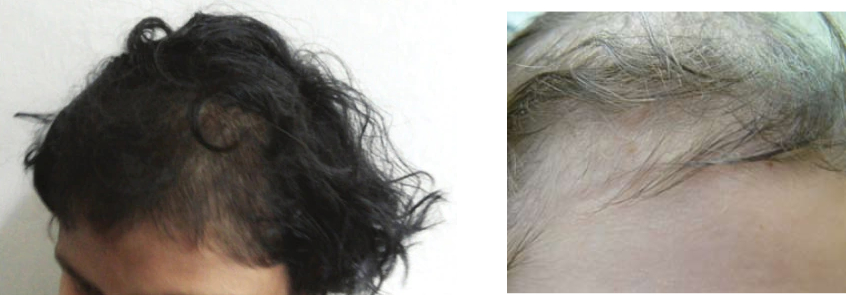 examples of Trichotillomania