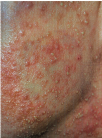 facial folliculitis