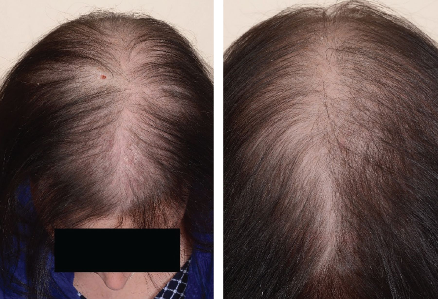 female pattern baldness patient