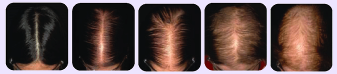 female pattern baldness stages