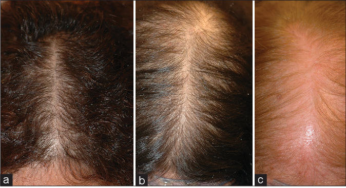 examples of female pattern hair loss