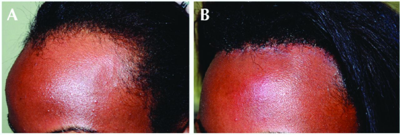 forehead reduction surgery before and after 1