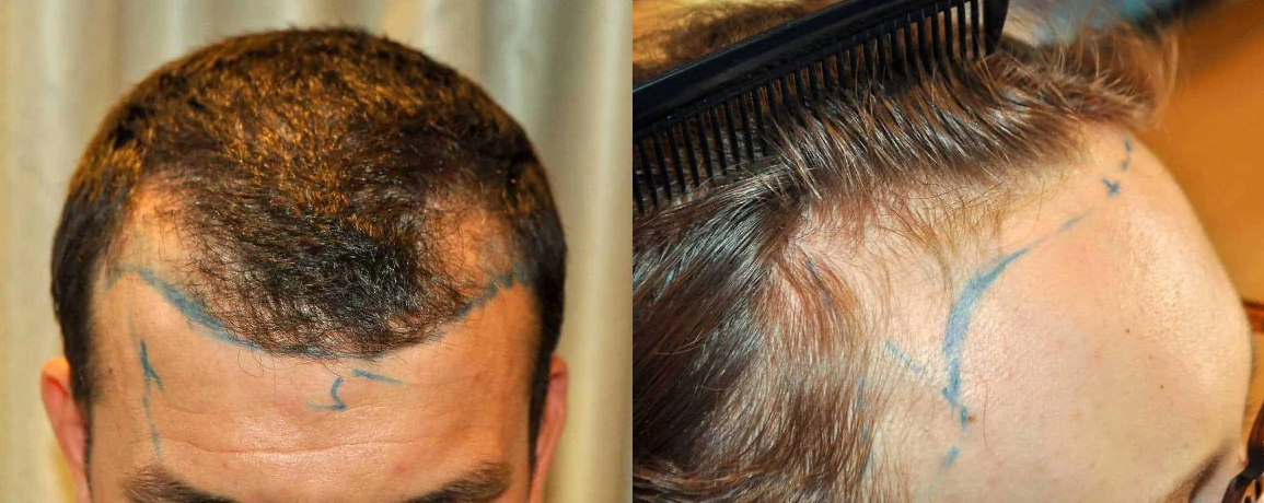 receding hairline examples