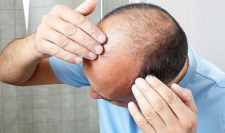 FUE Hair Transplant Results Featured Image