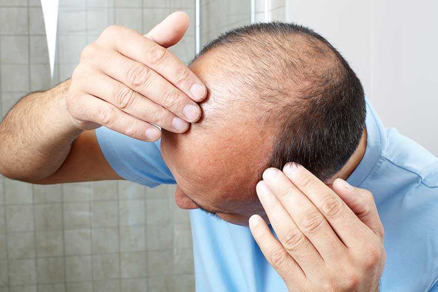 FUE Hair Transplant Results Featured Image