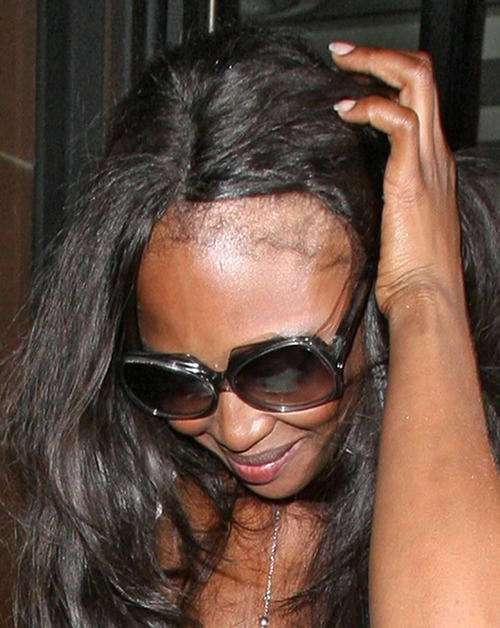 Naomi Campbell hair loss