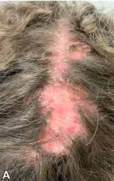 hair loss caused by folliculitis