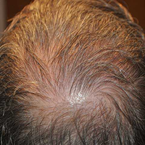 Crown Hair Transplant, Wimpole Clinic