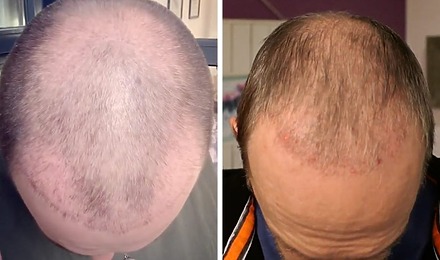 Hair Transplant After 2 Months: Photos, Results, Side Effects