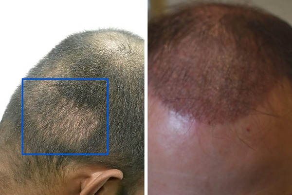 donor area and transplanted hair 1 month after hair transplant surgery