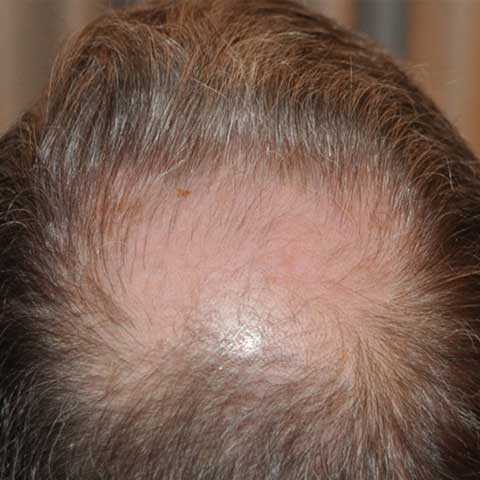 Crown Hair Transplant, Wimpole Clinic