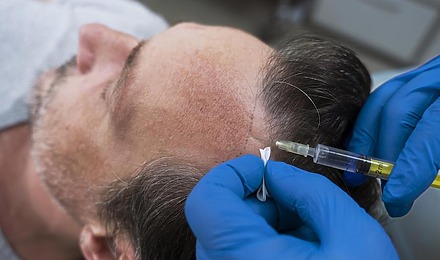 Hair Transplant Death Rate: Should You Be Worried?