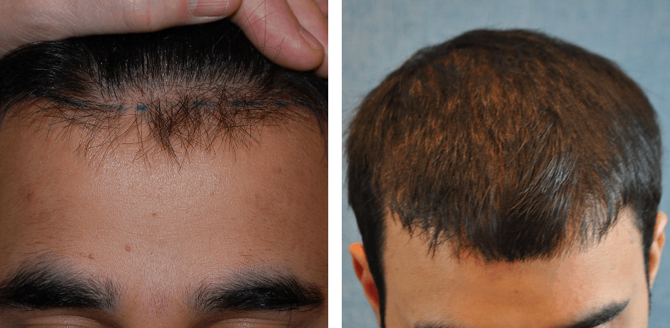 hair transplant in mid 20s