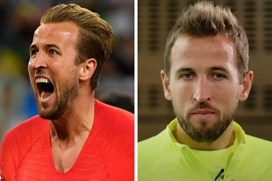 Harry Kane Hair Transplant Featured Image