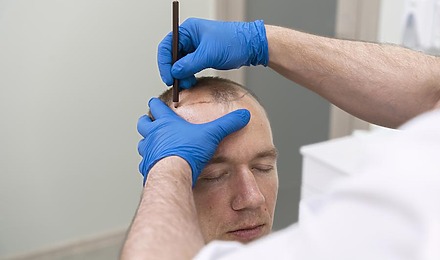 How Long Does A Hair Transplant Take?