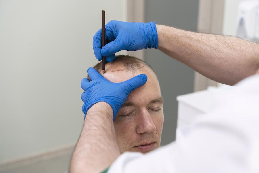 How Long Does A Hair Transplant Take?