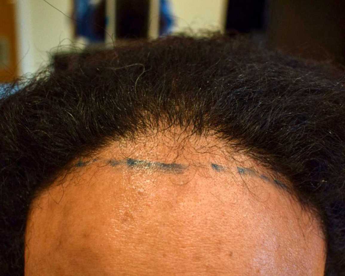 Hairline Transplant, Wimpole Clinic