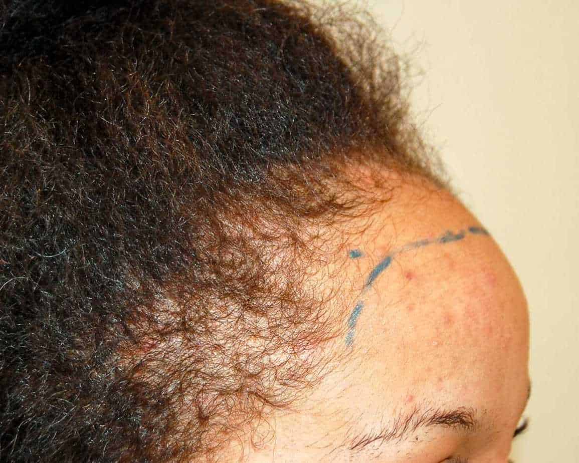 hairline before afro hair transplant