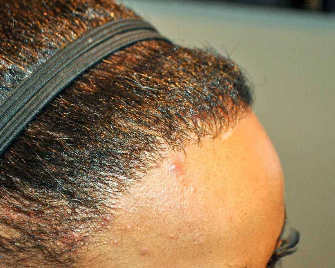 hairline after hair transplant