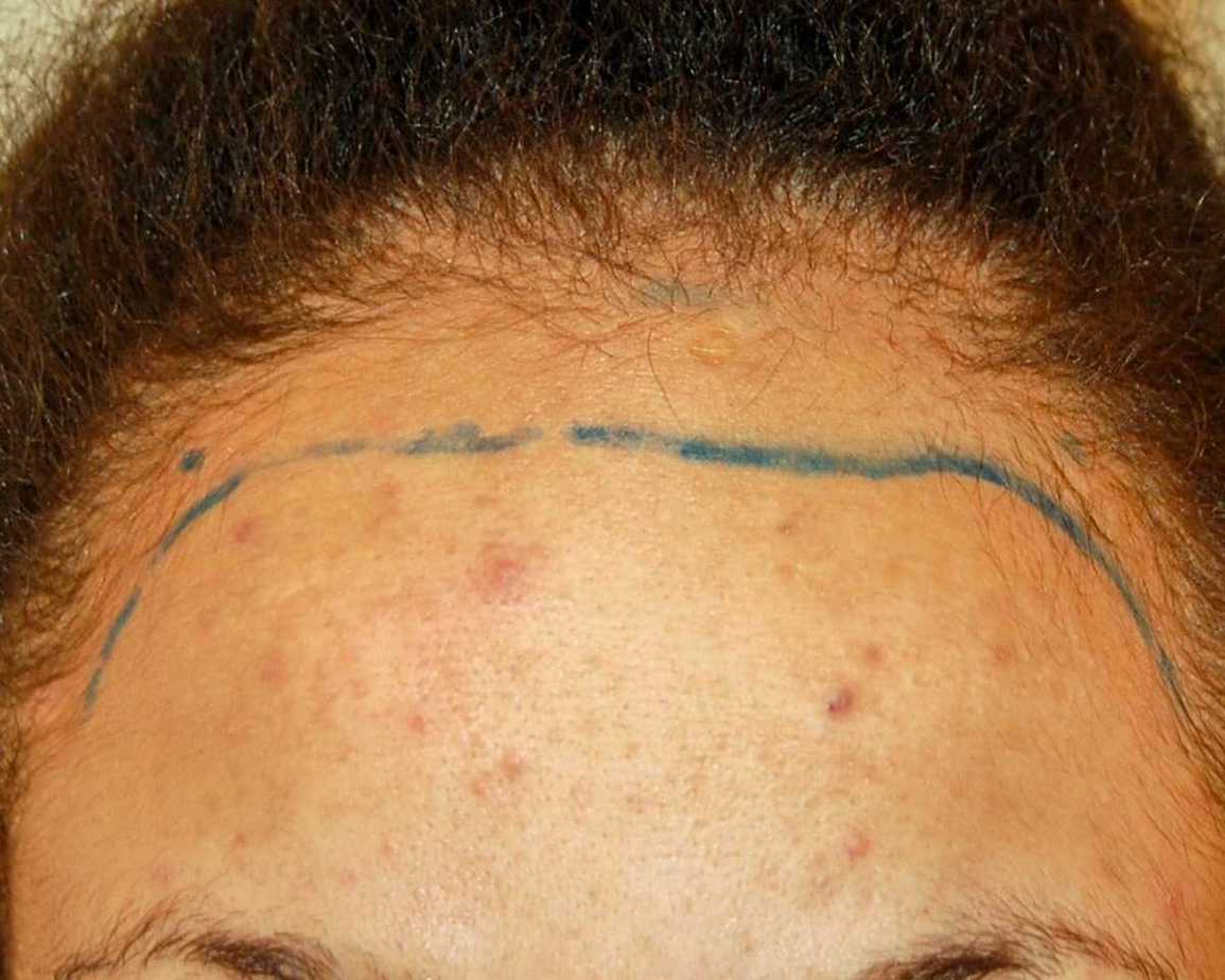 Female Hair Transplant, Wimpole Clinic