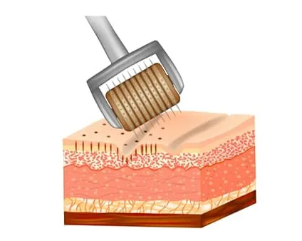 informational graphic showing how derma rolling works