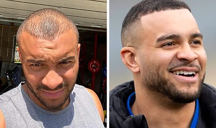 Jonathan Joseph Hair Transplant: Everything You Need To Know