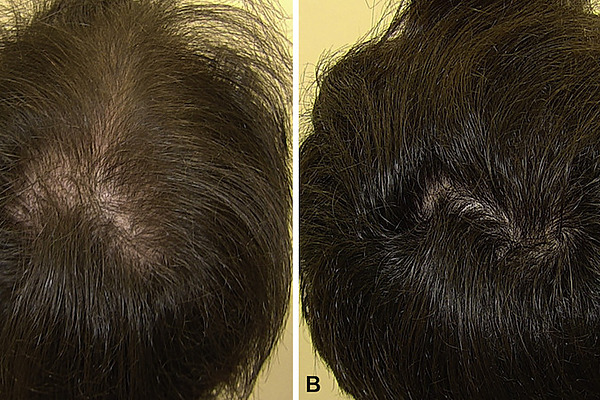 Minoxidil Before And After Featured Image